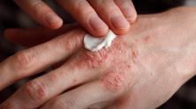 What Are Some Natural Remedies for Psoriasis?