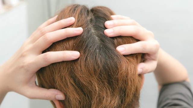 Home Remedies for a Dry Scalp