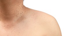 6 Common Causes of Skin Tags